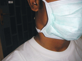 Ekstrapulmonal tuberkulose forekommer hyppigere blant hivpositive. Denne pasienten hadde glandeltuberkulose p&aring; halsen og&hellip;