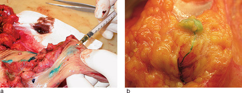 Figur 2  P&aring;visning av vaktpostlymfeknuter ex vivo. a) Bl&aring;farge injiseres under mucosa i fire kvadranter omkring svulsten&hellip;