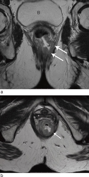 Figur 5  MR av distal rectumcancer i a) koronal og b) aksial retning. Tumor infiltrerer musculus levator ani og&hellip;