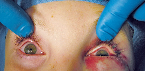 Figur 3  Hypoglobus p&aring; venstre side