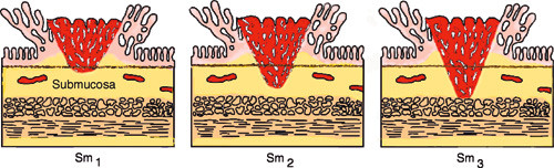 Figur 2  Klassifikasjon for bredbasede polypper. Cancerinfiltrasjon i tre niv&aring;er i submucosa (sm), kalt sm 1&thinsp;&ndash;&thinsp;3&hellip;