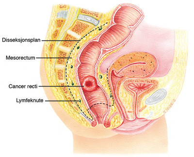 Figur 3  Total mesorektal eksisjon for rectumcancer. Mesorectum, fettvevet som omgir tarmr&oslash;ret, inneholder bl.a&hellip;