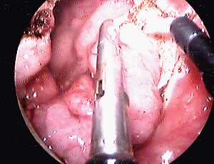 Figur 4  Reseksjon av et adenom i rectum sett med forst&oslash;rrelse gjennom linsene i et apparat for transanal endoskopisk&hellip;
