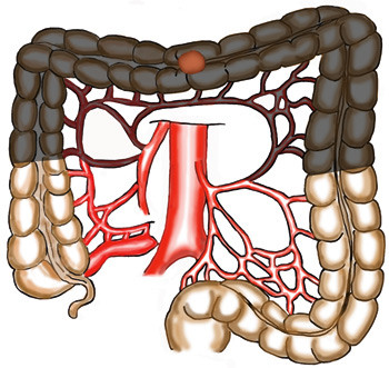 Figur 4  Tumor i transversum: Reseksjon av transversum inkludert begge fleksurer. A. colica media settes av sentralt ved a&hellip;