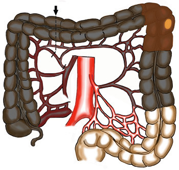 Firgur 5  Tumor i venstre fleksur: Standard er reseksjon av transversum til sigmoideum (vist med pil). A. colica media&hellip;