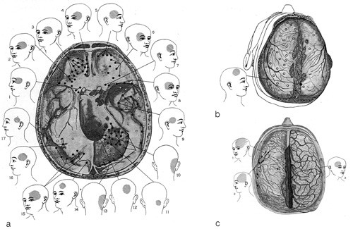 Figur 2  Referert smerte fra intrakraniale strukturer. Figuren viser hvor pasienter anga smerte ved stimulering av dura og&hellip;