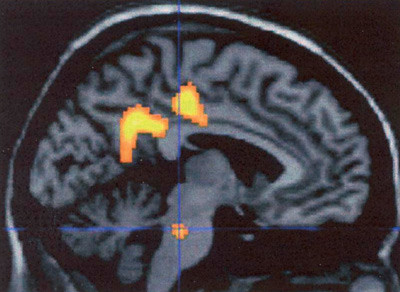 Figur 4  Migrenegenerator i hjernestammen? Et konsistent funn ved PET-unders&oslash;kelser av hjernen under migreneanfall er&hellip;