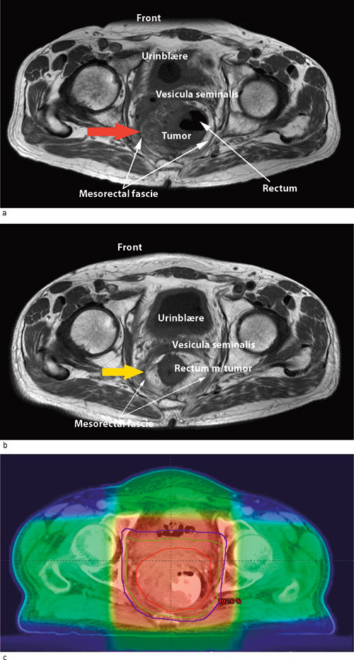 Figur 2  Lokalavansert endetarmssvulst, f&oslash;r og etter str&aring;ling, og str&aring;leplan. a) MR (T1-sekvens) av lokalavansert tumor i&hellip;