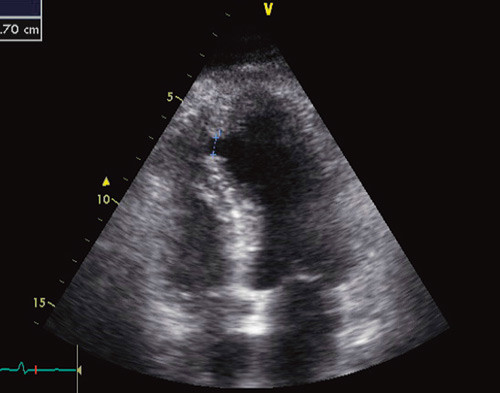 Figur 2  Transtorakal ekkokardiografi viser tydelig en 0,7 cm stor ventrikkelseptumruptur n&aelig;r apexomr&aring;det