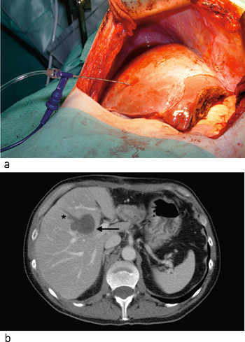 Figur 2  Kombinert leverreseksjon og radiofrekvensablasjon hos pasient med synkrone kolorektale levermetastaser. Det ble&hellip;