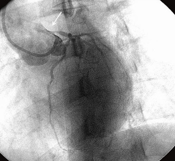 Figur 2  Koronar angiografi av venstre koronararterie der venstre hovedstamme har en uttalt stenose (pil)
