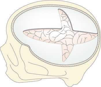Figur 2  Fremgangsm&aring;ten ved hemikraniektomi. Det er gjort en stor &aring;pning i kraniet &ndash; &laquo;fra sinus til sinus til sinus&raquo; &ndash; med&hellip;