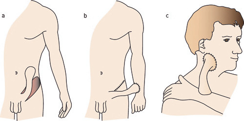 Figur 2  R&oslash;rlapp. Denne teknikken tillater flytting av vev fra et donorsted som ligger langt unna mottakerstedet. Her h&oslash;stes&hellip;