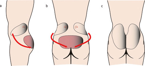 Figur 4  Sommerfuglplastikk. a, b) Ved &aring; svinge inn to LAP-lapper fra flankene kan man dekke den store defekten med hud og&hellip;