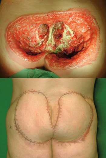 Figur 5  Stor sakral defekt. Sommerfuglplastikk med en LAP-lapp fra hver side er brukt til lukking av defekten. Gjengitt med&hellip;