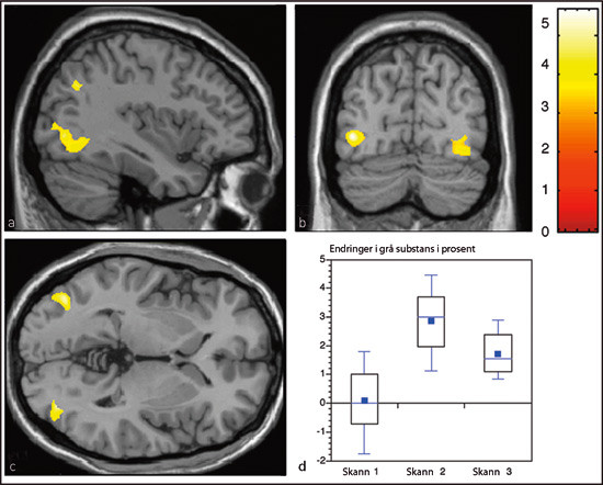 Figur 3  a) &Oslash;kt mengde gr&aring; substans i venstre sulcus intraparietalis (det &oslash;vre gule omr&aring;det) og a&thinsp;&ndash;&thinsp;c) midttemporalt&hellip;