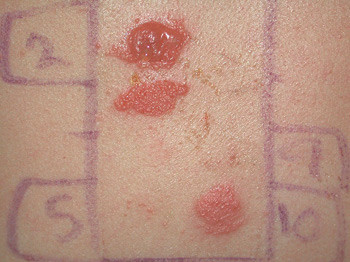 Figur 2  Positiv epikutantest med erytem, vesikler og bulla