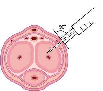 Figur 3  Ved injeksjonsbehandling av erektil dysfunksjon m&aring; de aktuelle substansene injiseres direkte inn i et av corporae&hellip;