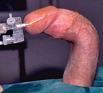 Figur 3  Medf&oslash;dt peniskrumning. Ereksjon fremkalt ved saltvannsinfusjon i forbindelse med korrigerende operasjon