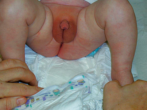 Figur 6  Behandling med 1 % DHT-kr&auml;m initierades under den f&ouml;rsta levnadsm&aring;naden, vilket resulterade i signifikant &ouml;kad&hellip;