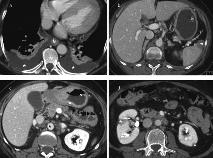 Figur 2  CT thorax og abdomen tatt f&aring; dager f&oslash;r pasienten d&oslash;de. a) Betydelig pleurav&aelig;ske (hvite stjerner). b) Infarkt i milt&hellip;