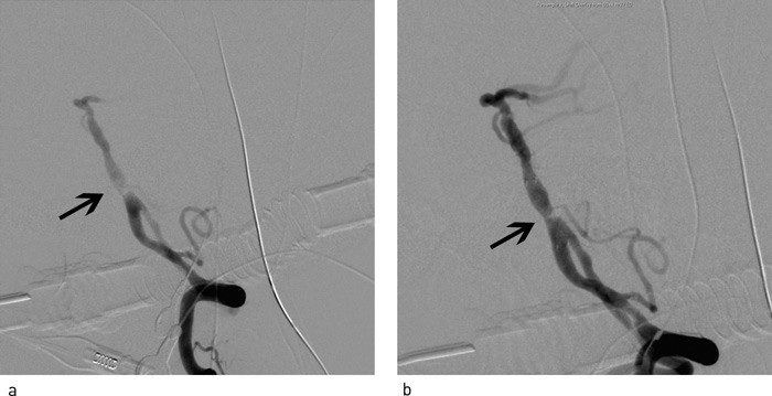 Figur 2  a) F&oslash;r og b) etter angioplastikk med Wingspan-stent plassert i det stenotiske partiet i a. basilaris (sidebilde,&hellip;
