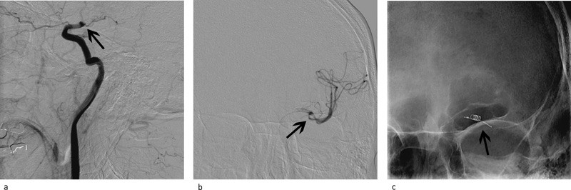 Figur 3  a) Kontrastinjeksjon i venstre a. carotis interna med stopp ved avgangen av a. choroidea anterior pga. trombe&hellip;