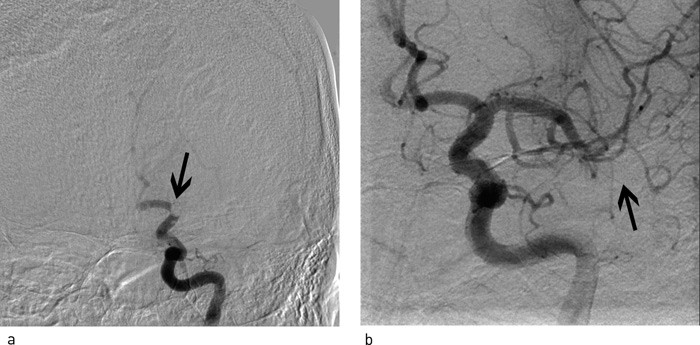 Figur 4  a) Resultatet etter f&oslash;rste passasje med MERCI-slynge (pil). Det er &aring;pnet for noe blodstr&oslash;m til a. cerebri anterior,&hellip;