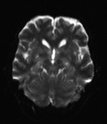 Figur 2  MR av cerebrum, diffusjonsvektet serie, tatt en uke senere viser at de bilaterale foci med diffusjonsrestriksjon i&hellip;