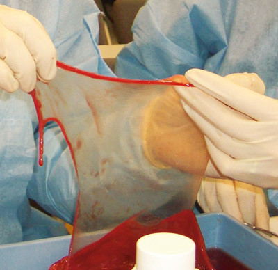 Figur 5  Preparering av amnionhinne