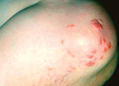 Figur 2  Eruptive xanthomer. Foto Leiv Ose, Lipidklinikken