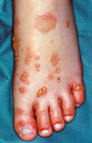 Figur 2  Vesikler og bullae p&aring; fot