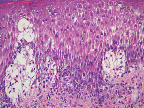 Figur 3  Histologisk pr&oslash;ve av utslett viser spongiose i epidermis med uttalt &oslash;dem i papill&aelig;re dermis. Det er &oslash;kt antall&hellip;