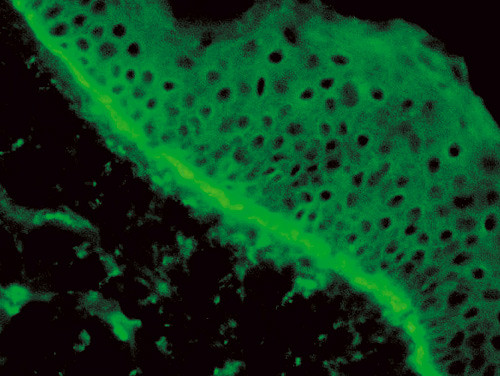 Figur 4  Immunfluorescens av utslett viser tydelige line&aelig;re nedslag av C3 langs basalmembranen