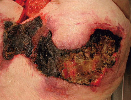 Figur 3  Kalsifylaksi og nekroser i huden over abdomen, fotografert ved obduksjonen. Omr&aring;det m&aring;lte n&aring; 20 x 30 cm