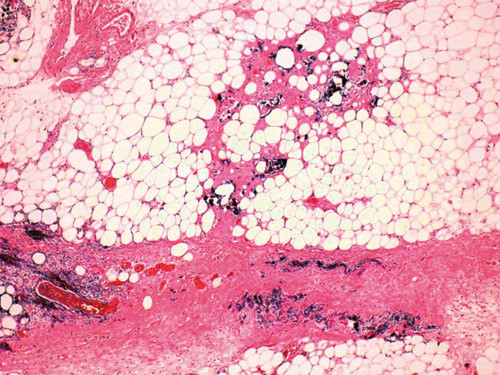 Figur 4  Lysmikroskopisk bilde av underhud og subkutant vev tatt fra bukregionen ved obduksjon. Det ses rikelig med&hellip;