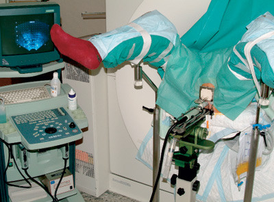 Figur 2  Pasient i behandlingsposisjon for h&oslash;ydoserate brakyterapi: Ultalydprobe i rectum, en mal (perforert plate) mot&hellip;