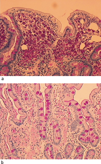Figur 2  a) Tynntarmsbiopsi ved diagnosetidspunktet. Et stort antall makrofager med rikelig PAS-positive inklusjoner ses i&hellip;