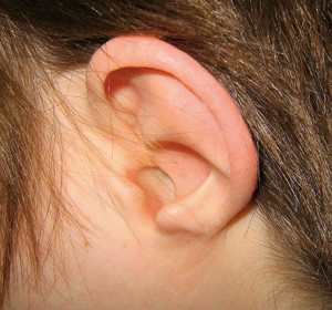 Figur 2  Typisk begerformet, dysplastisk &oslash;remusling hos et barn med CHARGE-syndrom. Foto privat. Gjengitt med tillatelse fra&hellip;