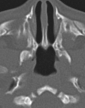 Figur 3  CT-bildet viser en membran&oslash;s bilateral koanalatresi. Bakre del av vomer er fortykket, og den beinete avstanden i&hellip;