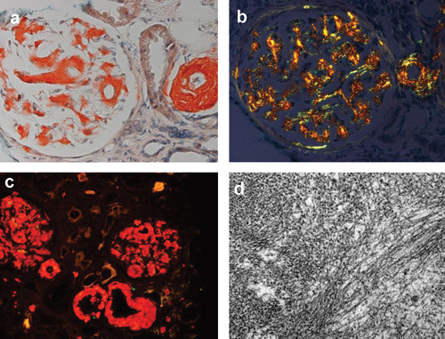 Figur 2  Diagnosen amyloidose stilles i biopsi. Vevssnitt fra nyre farget med kongor&oslash;dt viser amyloid i a) lysmikroskopi og&hellip;