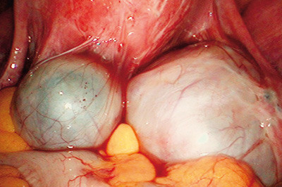 Figur 3  Bilaterale, adherente endometriomer (kissing ovaries)