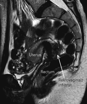 Figur 4  MR med rektovaginalt endometrioseinfiltrat