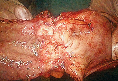 Figur 5  Endometrioseinfiltrat i rektosigmoideumresektat