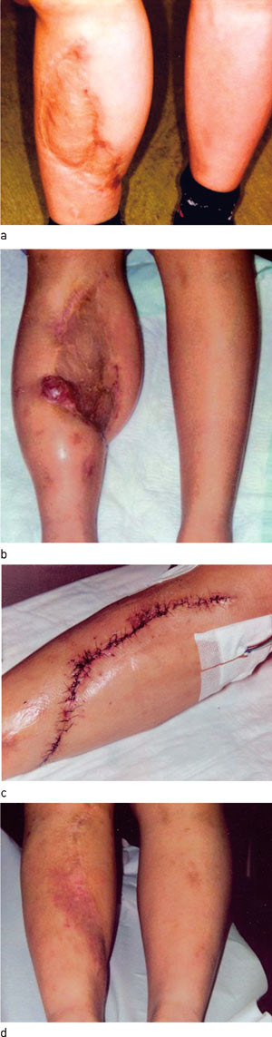 Figur 2  Sekvele etter traume hos ung kvinne. a) Defekt p&aring; legg (19 x 8 cm). b) Croissant- og rektangul&aelig;rekspandere lagt inn&hellip;