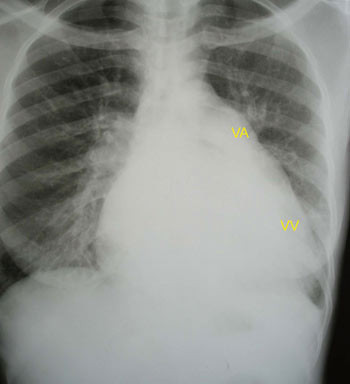 Figur 3  R&oslash;ntgen thorax av kvinne 20 &aring;r med kombinert mitral stenose/insuffisiens. Hjertesilhuett viser dilatert venstre&hellip;