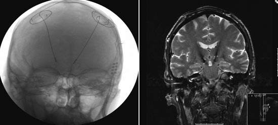 Figur 2  Dyp hjernestimulering i nucleus subthalamicus. R&oslash;ntgenbilde av hodet etter implantasjon av elektroder i&hellip;