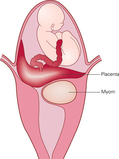 Figur 3 Skjematisk fremstilling av de anatomiske forandringene i uterus, der et intramuralt myom muligvis for&aring;rsaket deling&hellip;