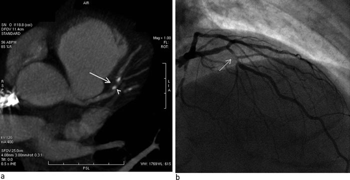 Figur 3  a) 16-detektor-CT-unders&oslash;king med framstilling av feittrikt (pil) og forkalka (pilhovud) plakk, der spesielt&hellip;