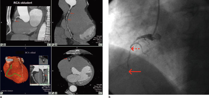 Figur 2  a) Koronar CT-angiografi: Okklusjoner (piler) med retrograd kontrastfylling av h&oslash;yre koronararterie. b) Invasiv&hellip;